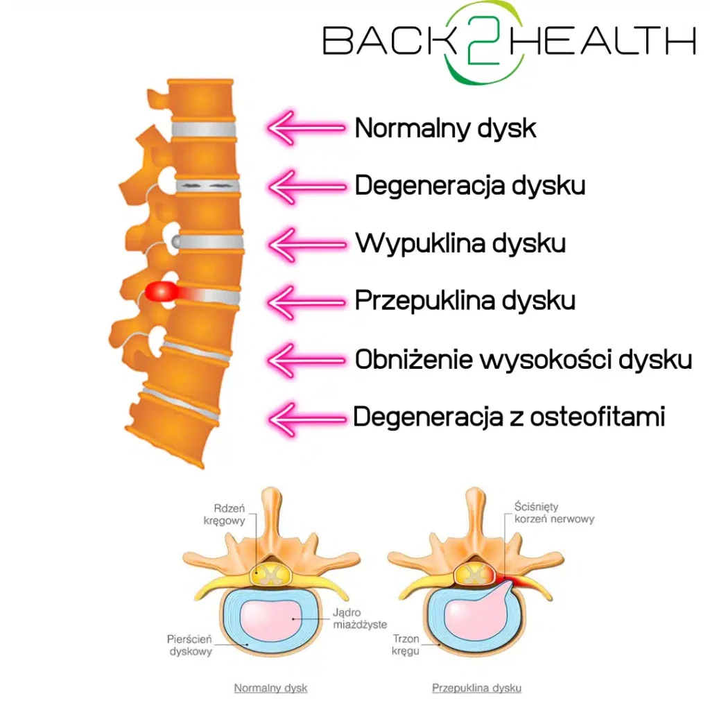 Mechanizm dyskopatii - infografika Back2Health